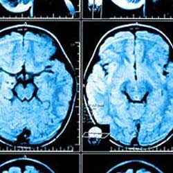 Texas Brain Injury Lawyer
