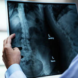 How Much Is a Spinal Cord Injury Worth in Texas?